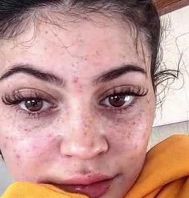 Kylie Jenner freckles and scars