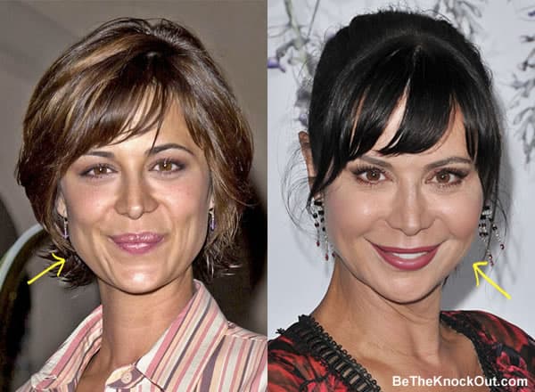 Did Catherine Bell have botox?