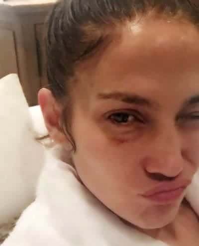 Jennifer Lopez with a black eye