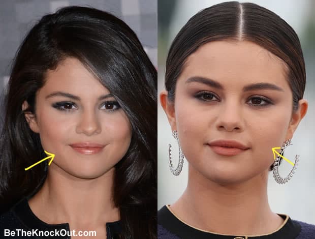 Did Selena Gomez have botox?