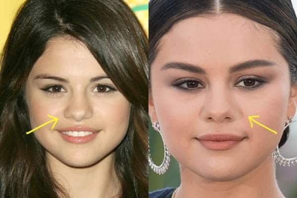 Did Selena get a nose job?