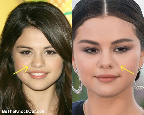 Did Selena get a nose job?