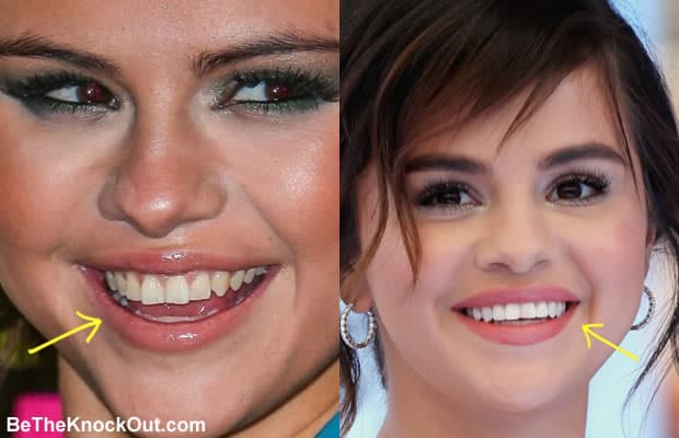 Any work done on Selena's teeth?