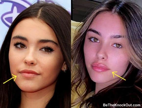 Did Madison Beer have lip injections?
