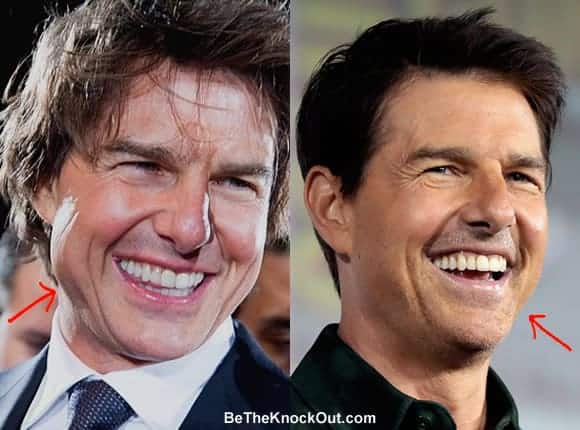 Has Tom Cruise had a facelift?