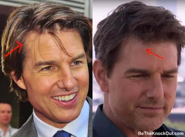 Did Tom Cruise have a hair transplant?