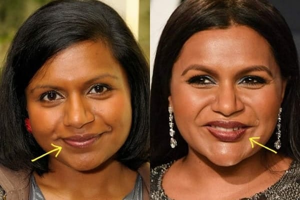 Has Mindy Kaling has lip injections?
