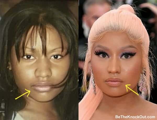 Did Nicki Minaj get lip injections?