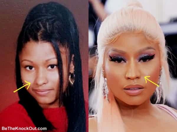 Did Nicki Minaj have a nose job?
