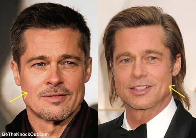 Did Brad Pitt have botox?
