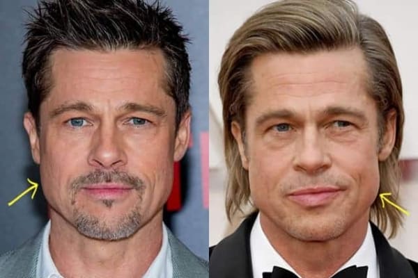 Brad Pitt Plastic Surgery Comparison Photos