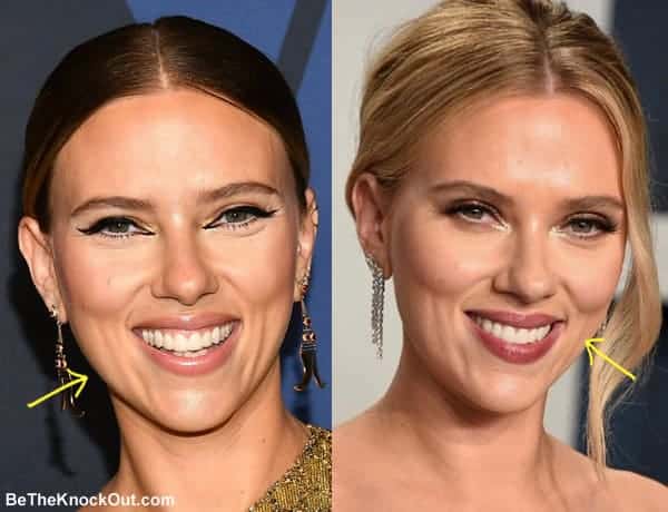 Did Scarlett Johansson have botox?