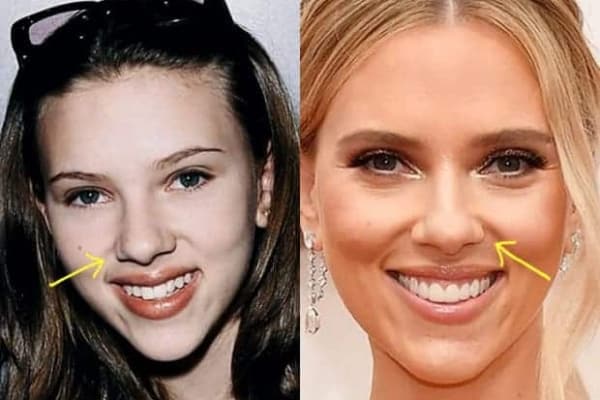 Scarlett Johansson Plastic Surgery Comparison Photos