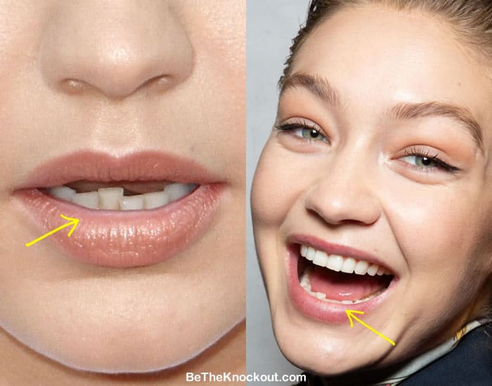 Gigi Hadid crooked teeth before and after comparison photo
