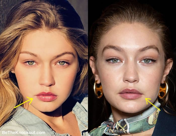 Gigi Hadid lip injections before and after comparison photo