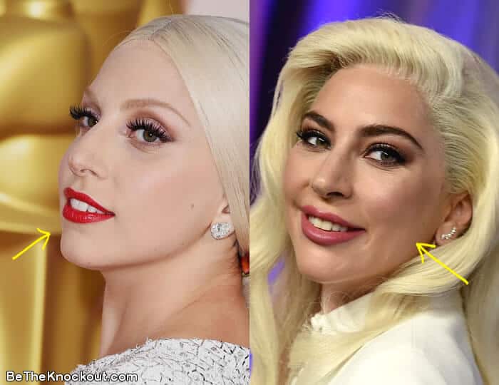 Lady Gaga botox before and after comparison photo
