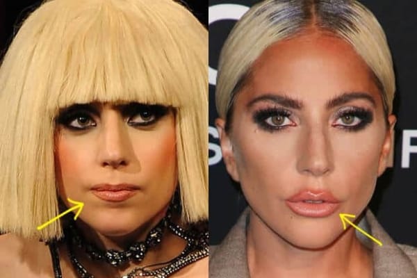 Lady Gaga lip injections before and after comparison photo