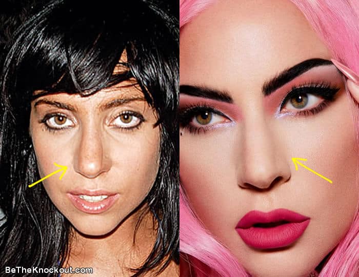 Lady Gaga nose job before and after comparison photo