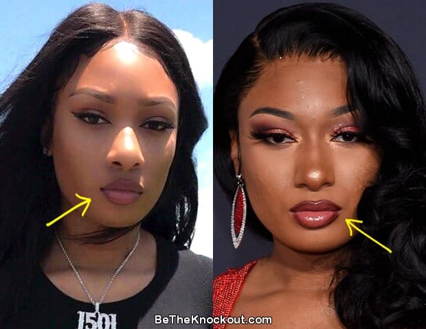 Did Megan Thee Stallion get lip injections?