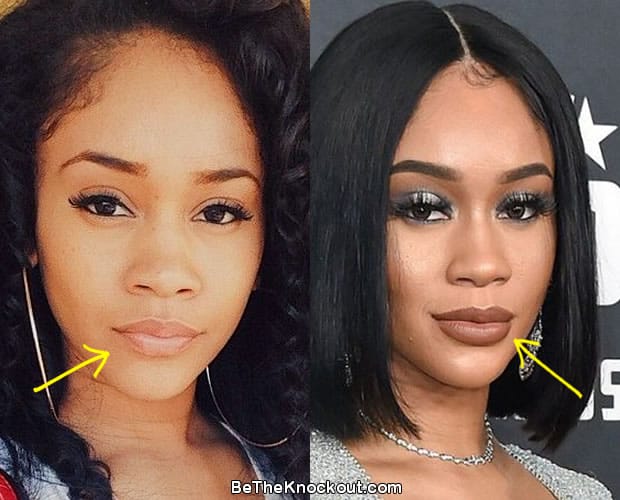 Saweetie lip injections before and after comparison photo