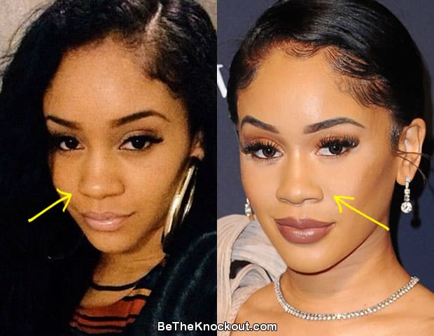Saweetie nose job before and after comparison photo