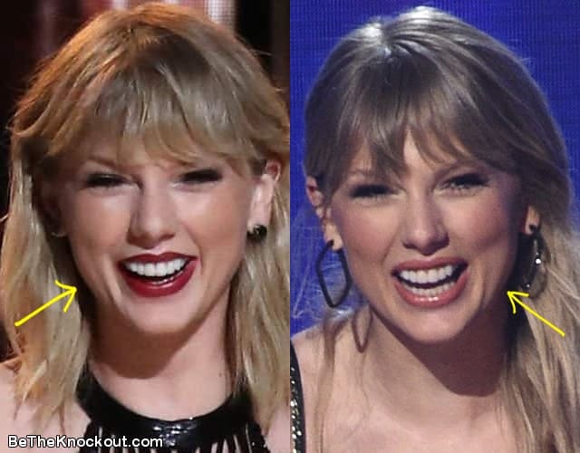 Taylor Swift botox before and after comparison photo
