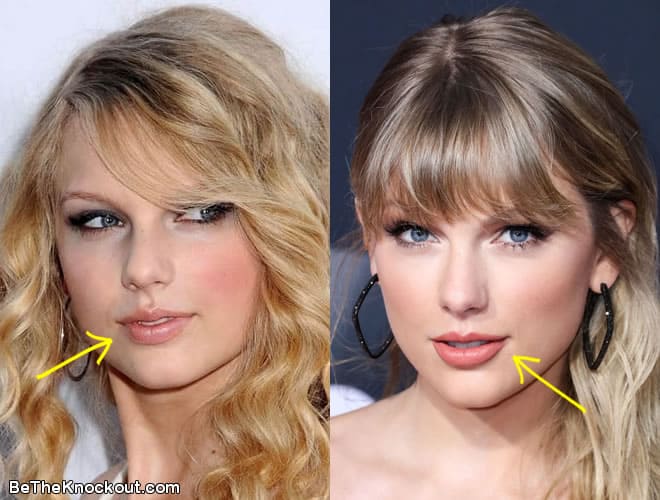 Taylor Swift lip fillers before and after comparison photo