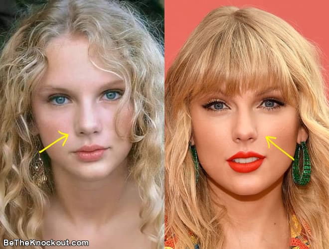 Taylor Swift nose job before and after comparison photo