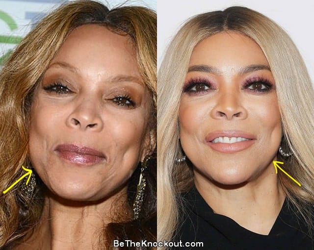 Wendy Williams facelift before and after comparison photo