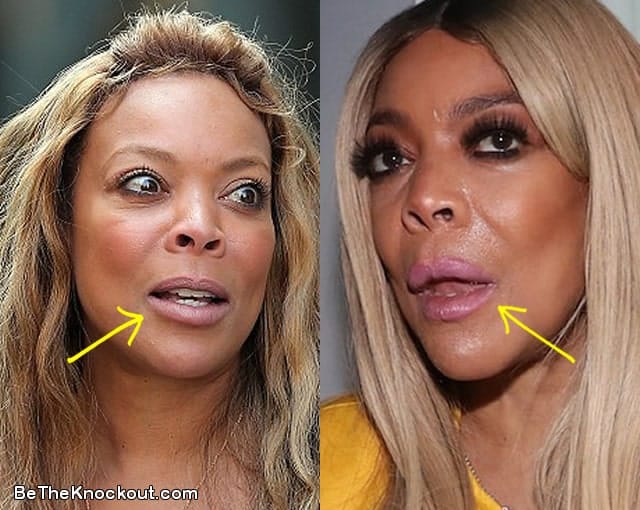Wendy Williams lip fillers before and after comparison photo