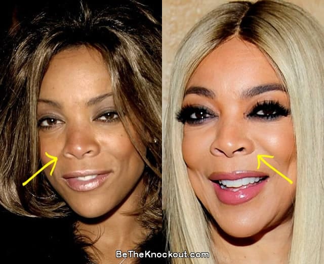 Wendy Williams nose job before and after comparison photo