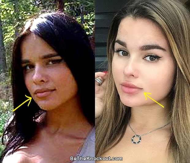 Anastasia Kvitko lip injections before and after photo comparison