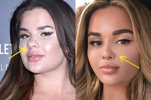 Anastasia Kvitko nose job before and after photo comparison