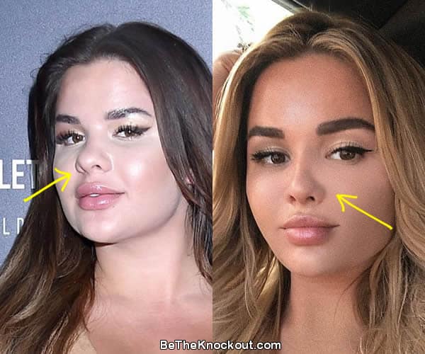 Anastasia Kvitko nose job before and after photo comparison
