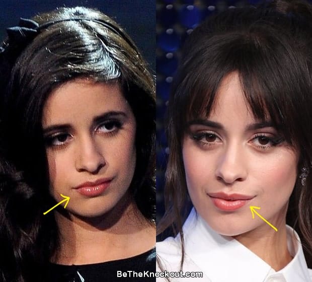 Camila Cabello lip injections before and after comparison photo