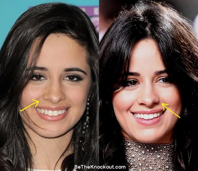 Camila Cabello nose job before and after comparison photo