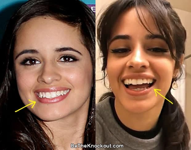 Camila Cabello teeth before and after comparison photo