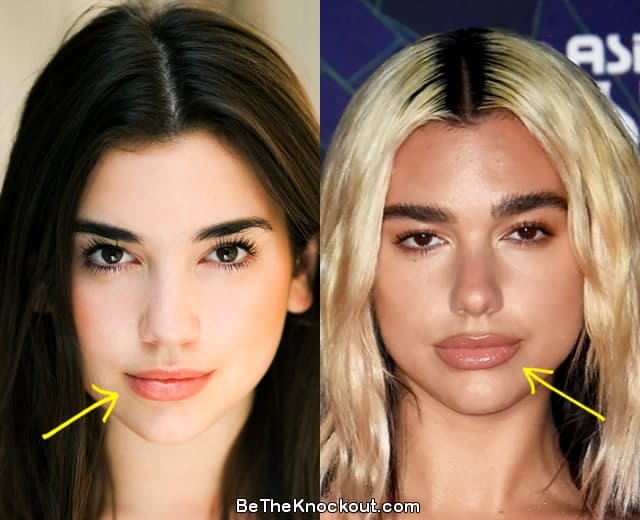 Dua Lipa lip injections before and after photo comparison