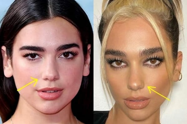 Dua Lipa nose job before and after photo comparison
