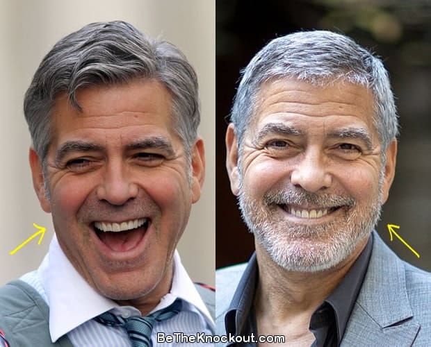 George Clooney botox before and after photo comparison