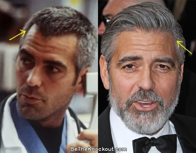 George Clooney hair transplant before and after photo comparison