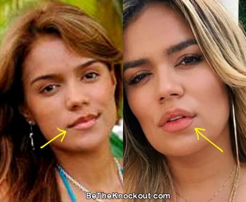 Karol G lip injections before and after comparison photo