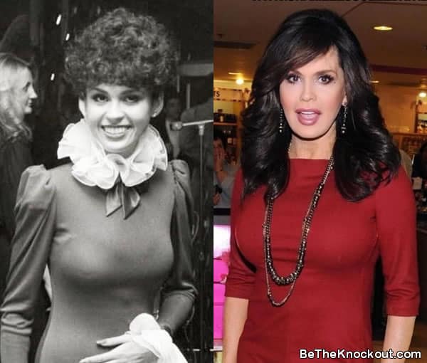 Marie Osmond boob job before and after comparison photo