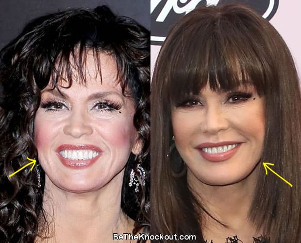 Marie Osmond botox before and after comparison photo