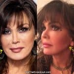 Marie Osmond facelift before and after comparison photo
