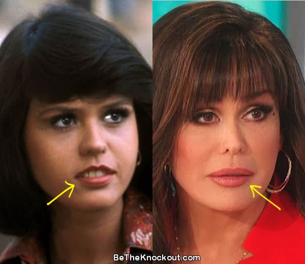 Marie Osmond lip fillers before and after comparison photo