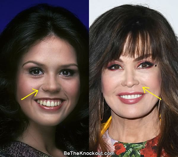Marie Osmond nose job before and after comparison photo