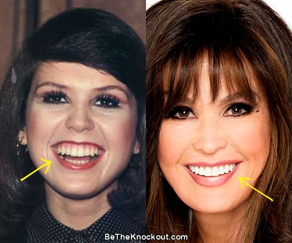 Marie Osmond teeth before and after comparison photo
