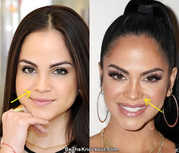 Natti Natasha nose job before and after comparison photo