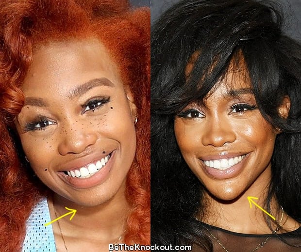 SZA chin implant before and after comparison photo
